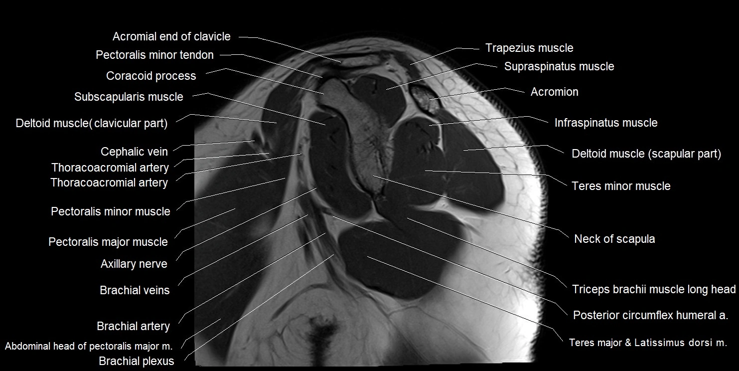 mri shoulder sagittal cross sectional anatomy image 5.webp